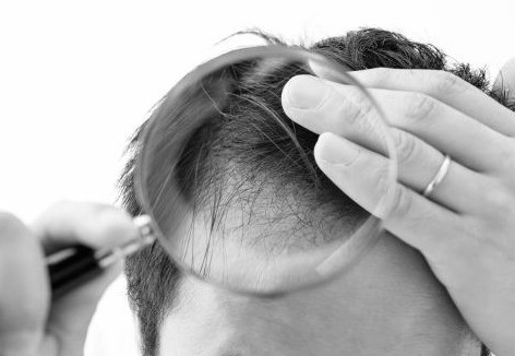 Kampf dem schütteren Haar mit Scalp Optic Hair